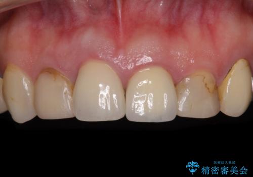 鼻の下を押すと痛い 抜歯を避けてきた歯を抜歯して自然な口元にの症例 治療前