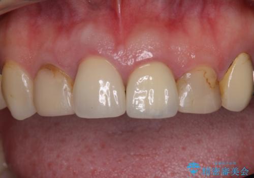 鼻の下を押すと痛い 抜歯を避けてきた歯を抜歯して自然な口元にの治療前