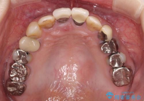 鼻の下を押すと痛い 抜歯を避けてきた歯を抜歯して自然な口元にの治療前