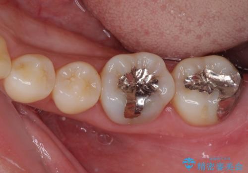 奥歯が痛い　保険治療後に症状が発現した歯のむし歯治療の症例 治療前