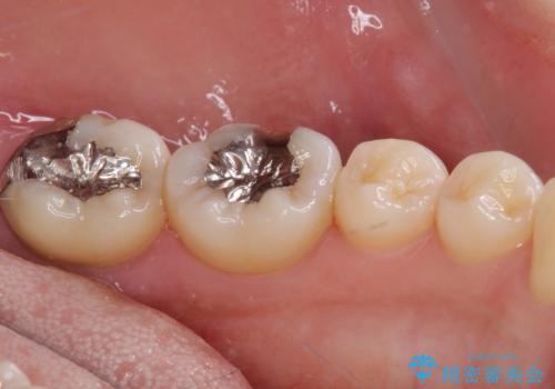 奥歯が痛い 保険治療後に症状が発現した歯のむし歯治療の治療前