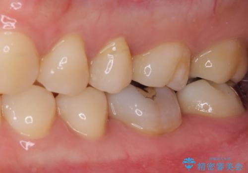 奥歯が痛い　保険治療後に症状が発現した歯のむし歯治療の治療前