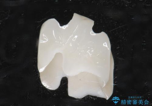 銀歯の下が虫歯になっている セラミックインレー 30代女性の治療後