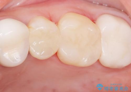 銀歯の下が虫歯になっている セラミックインレー 30代女性の治療後