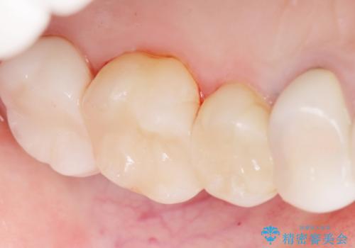 銀歯の下が虫歯になっている　セラミックインレー　30代女性の治療後