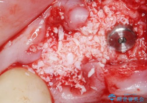 喫煙を再開してインプラント周囲炎に リカバリー治療 50代男性の治療中
