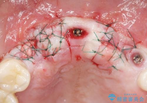 喫煙を再開してインプラント周囲炎に リカバリー治療 50代男性の治療中