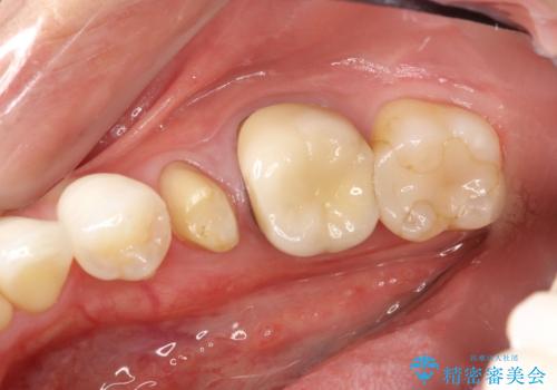 歯肉にできものがある、根管治療からセラミッククラウンまでの治療前