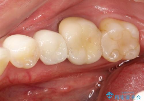 歯肉にできものがある、根管治療からセラミッククラウンまでの治療前