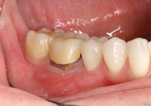 歯肉にできものがある、根管治療からセラミッククラウンまでの治療中