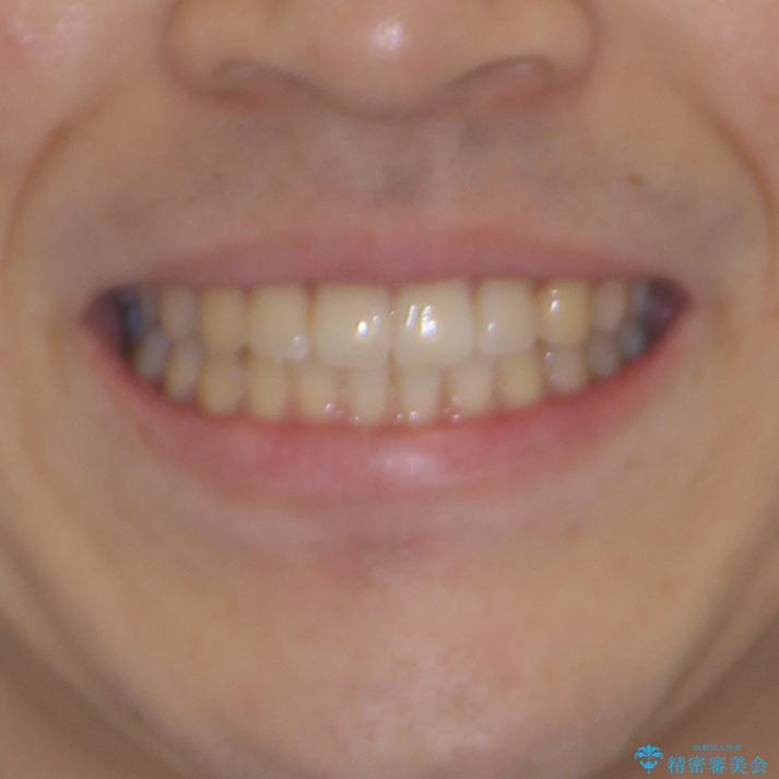 インビザライン・ライトによる矯正治療の後戻り改善の治療後(顔貌)