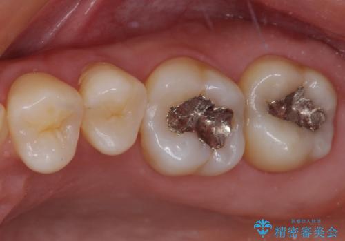 奥歯が痛い 保険治療後に症状が発現した歯のむし歯治療の治療前