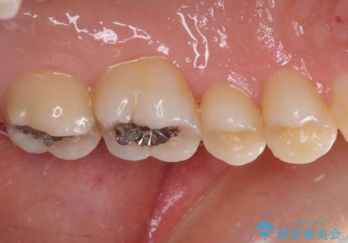 奥歯が痛い 保険治療後に症状が発現した歯のむし歯治療の治療前