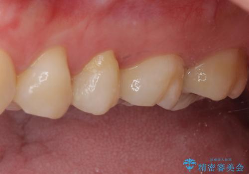奥歯が痛い 保険治療後に症状が発現した歯のむし歯治療の治療前