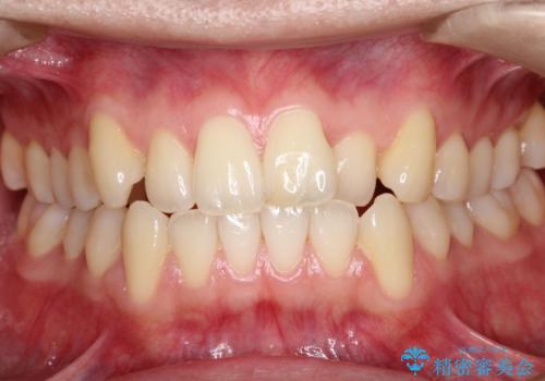 【クリア装置】前歯の凸凹を綺麗にしたいの症例 治療前