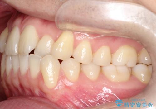 【クリア装置】前歯の凸凹を綺麗にしたいの治療前