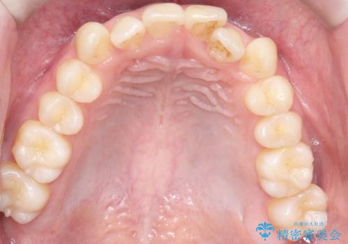 【クリア装置】前歯の凸凹を綺麗にしたいの治療前