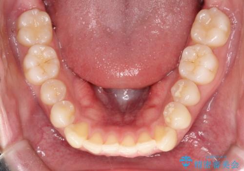 【クリア装置】前歯の凸凹を綺麗にしたいの治療前