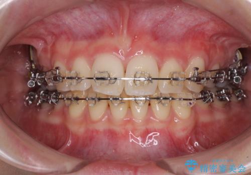治療途中で転院 抜歯矯正の仕上げ治療の治療中