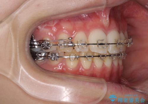 治療途中で転院 抜歯矯正の仕上げ治療の治療中