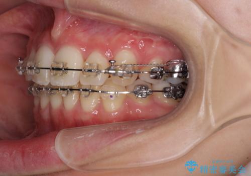 治療途中で転院 抜歯矯正の仕上げ治療の治療中