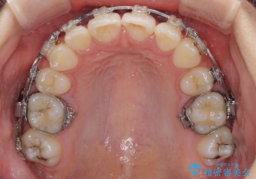 治療途中で転院 抜歯矯正の仕上げ治療の治療中
