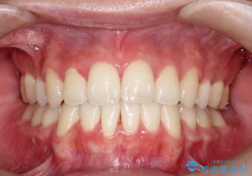 口元が出てるの気になる ハーフリンガルによる抜歯矯正での横顔改善の治療後