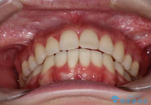 口元が出てるの気になる ハーフリンガルによる抜歯矯正での横顔改善の治療後