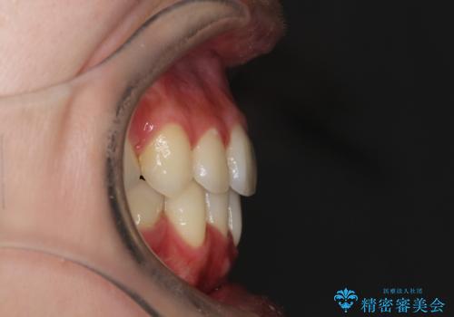 口元が出てるの気になる ハーフリンガルによる抜歯矯正での横顔改善の治療後