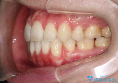 口元が出てるの気になる ハーフリンガルによる抜歯矯正での横顔改善の治療後