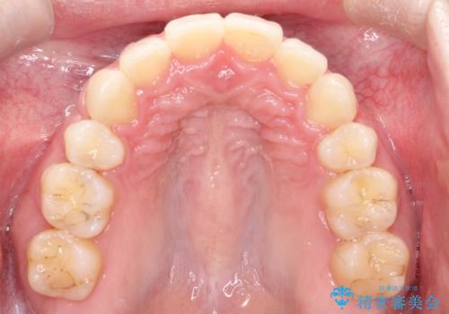 口元が出てるの気になる ハーフリンガルによる抜歯矯正での横顔改善の治療後