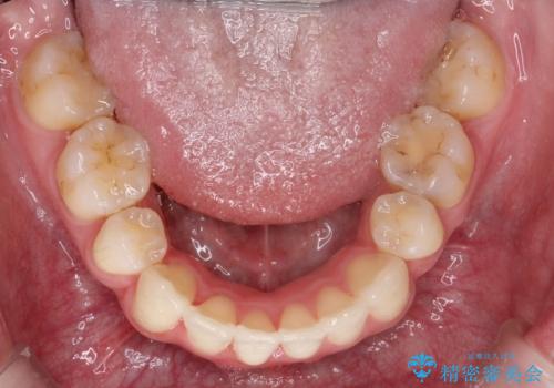 口元が出てるの気になる ハーフリンガルによる抜歯矯正での横顔改善の治療後