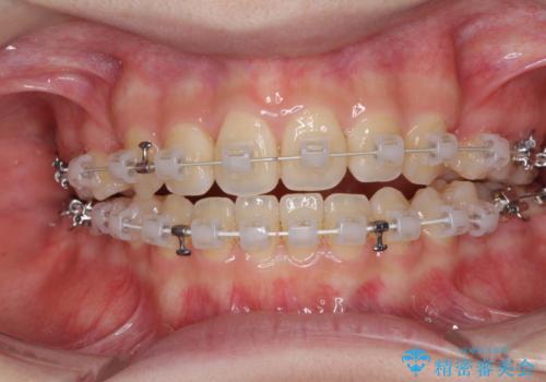 話しにくいオープンバイト ワイヤー装置による抜歯矯正治療の治療中