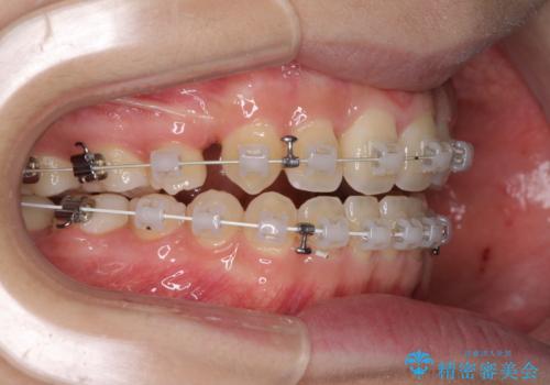 話しにくいオープンバイト ワイヤー装置による抜歯矯正治療の治療中