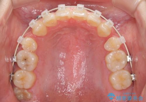 話しにくいオープンバイト ワイヤー装置による抜歯矯正治療の治療中