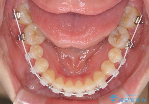 話しにくいオープンバイト ワイヤー装置による抜歯矯正治療の治療中