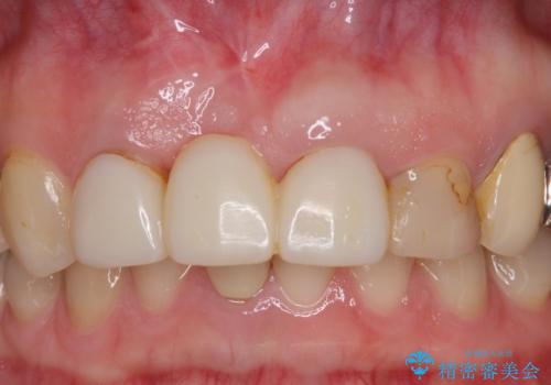 鼻の下を押すと痛い 抜歯を避けてきた歯を抜歯して自然な口元にの治療中