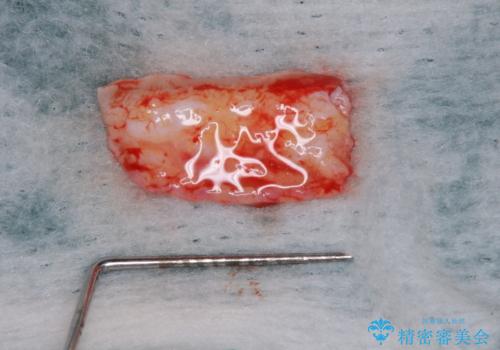 鼻の下を押すと痛い 抜歯を避けてきた歯を抜歯して自然な口元にの治療中