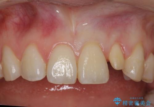 小さい前歯を整える　セラミック矯正の治療中