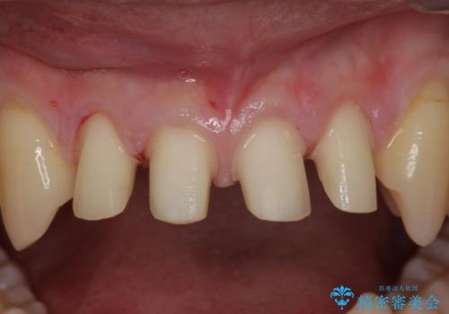 前歯のすき間 セラミックで綺麗に 最短で治療の治療中