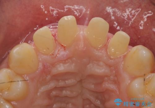 前歯のすき間 セラミックで綺麗に 最短で治療の治療中