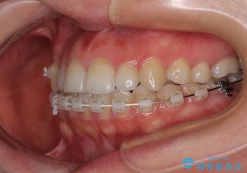 目立ちにくい抜歯矯正 ハーフリンガルの治療中