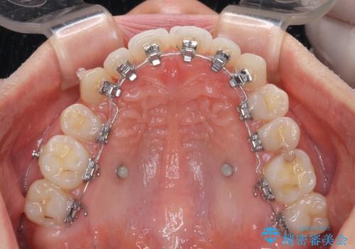 目立ちにくい抜歯矯正 ハーフリンガルの治療中