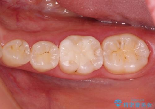 セラミックとゴールド　奥歯のむし歯治療の症例 治療後