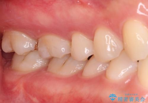 セラミックとゴールド 奥歯のむし歯治療の治療後