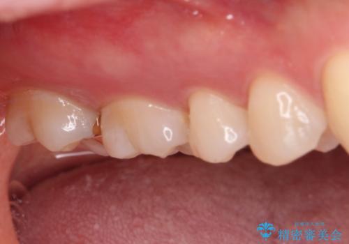 セラミックとゴールド 奥歯のむし歯治療の治療後