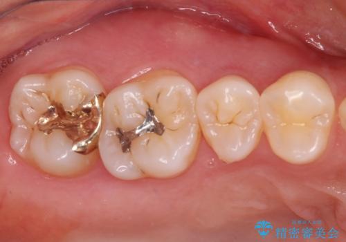 セラミックとゴールド　奥歯のむし歯治療の治療後