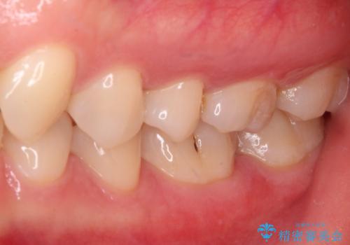 セラミックとゴールド 奥歯のむし歯治療の治療後