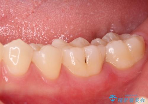 セラミックとゴールド 奥歯のむし歯治療の治療後