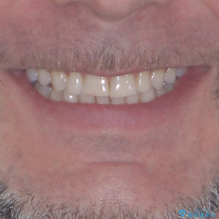 抜歯矯正の後戻りが気になる インビザライン・ライトによる矯正治療の治療後(顔貌)
